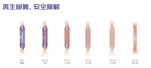 正式啟動臨床應(yīng)用！全國首批生物可降解房缺封堵術(shù)圓滿成功！